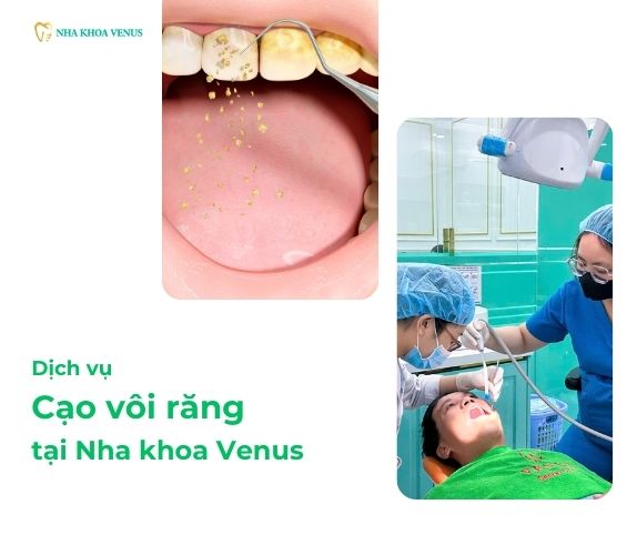 Cạo vôi răng 3 dịch vụ Cạo vôi răng tại Nha khoa Venus