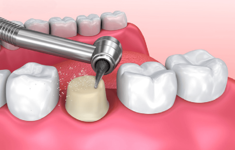 Bọc răng sứ có phải mài răng không? Tỷ lệ chuẩn y khoa 6 Mài cùi răng
