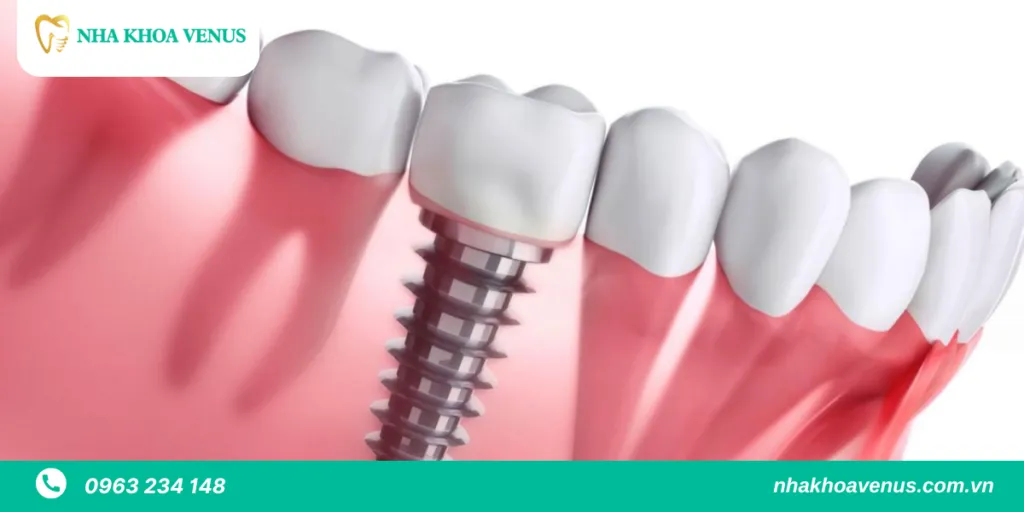 Trồng răng Implant có đau không? Những cách giảm đau hiệu quả khi cấy ghép Implant?