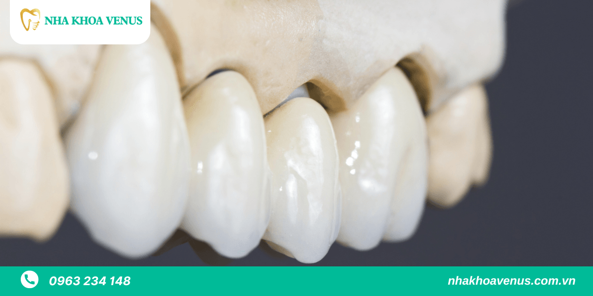 Cầu răng sứ và Implant