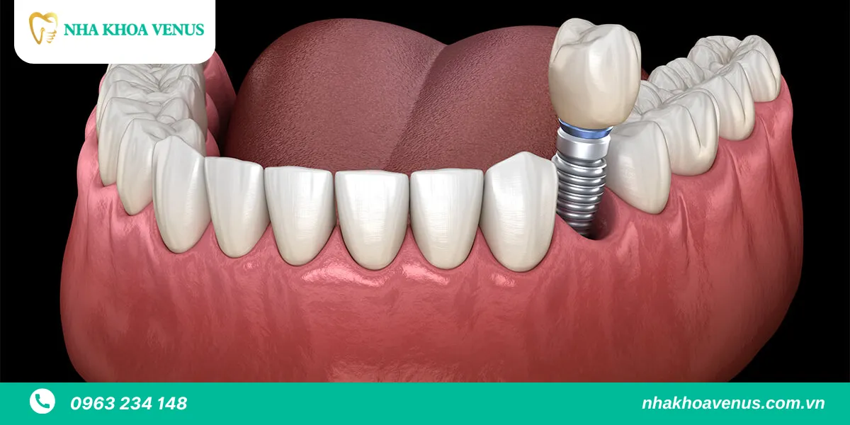 mất răng lâu năm có trồng implant được không
