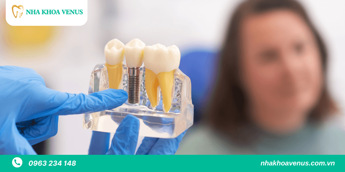 Quy trình cấy ghép Implant