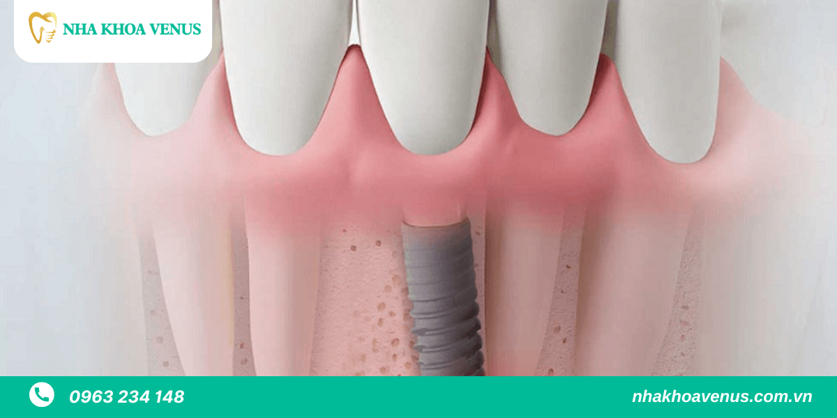 Tác hại của việc trồng răng Implant