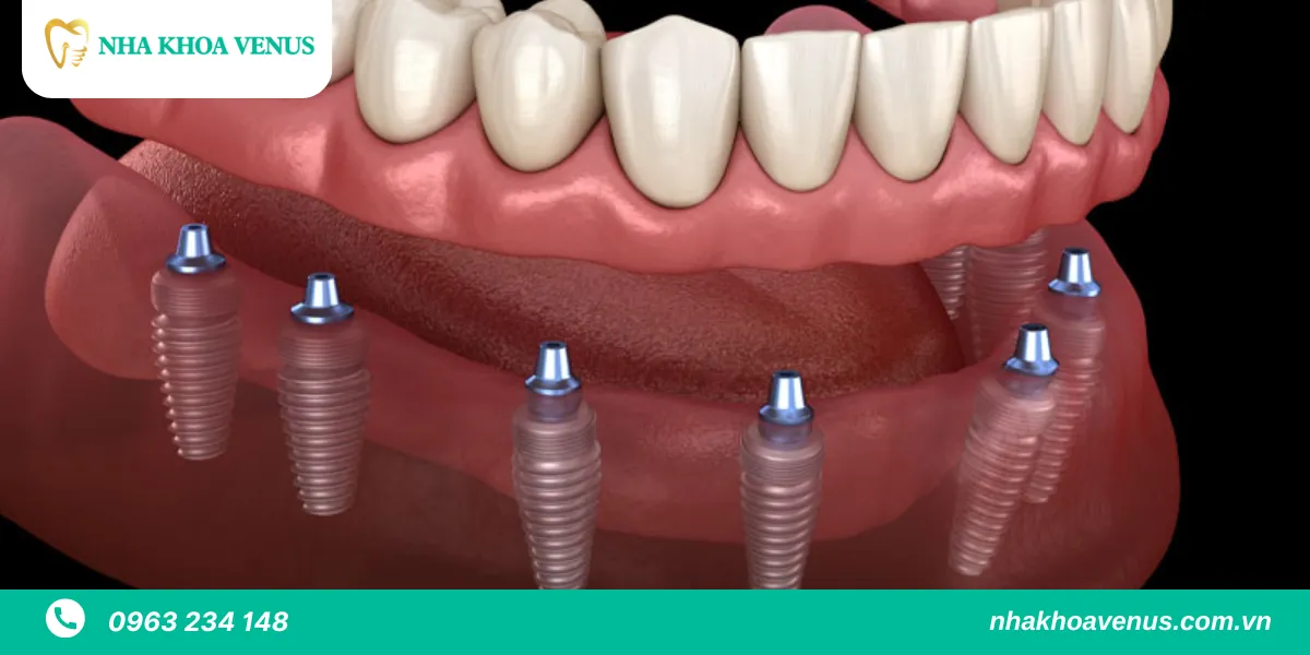 trồng Implant All-On-6
