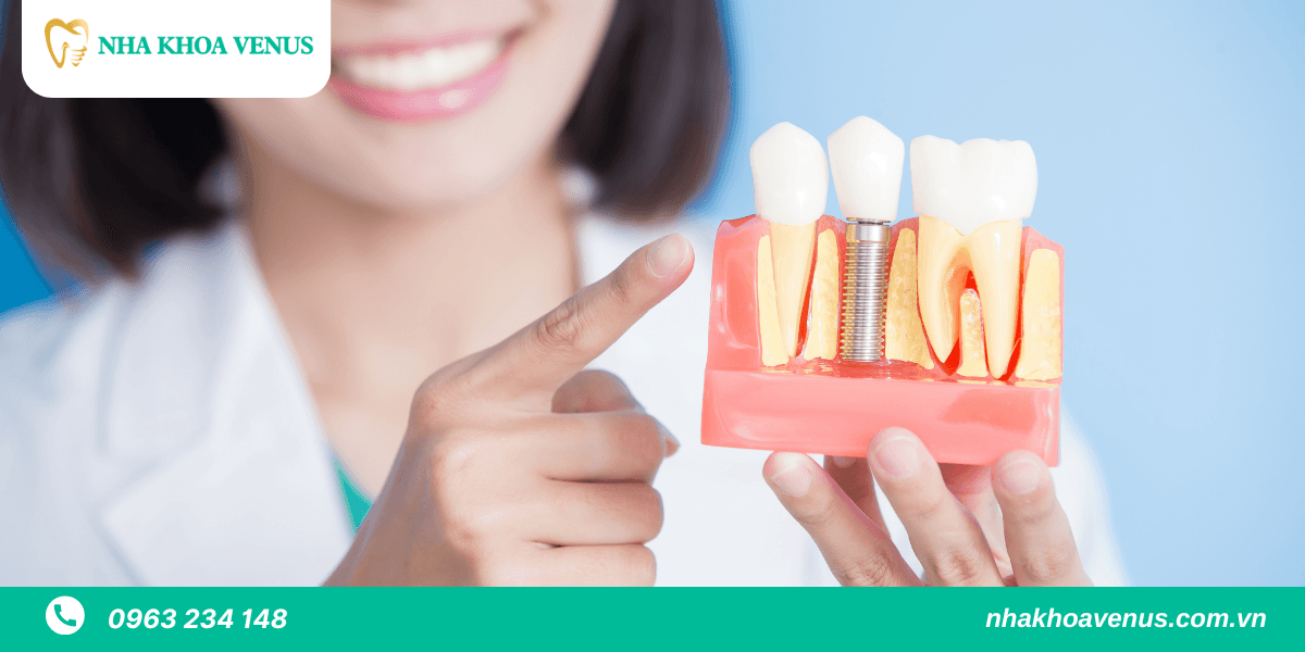 Trồng răng Imlant mất bao lâu