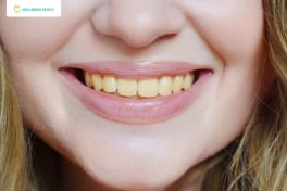 Cạo vôi răng 4 Người có màu răng bị màu ố vàng