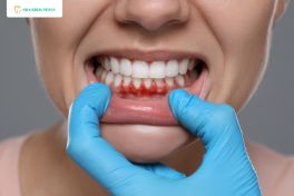 Cạo vôi răng 6 Người đang gặp các vấn đề về nướu