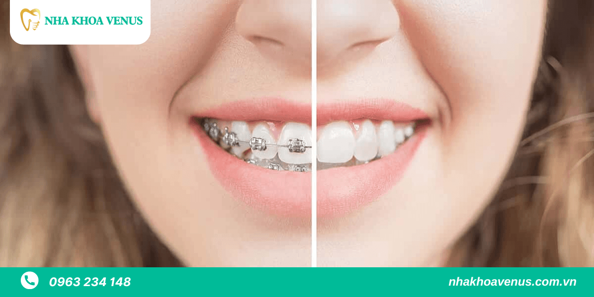 răng sau khi niềng