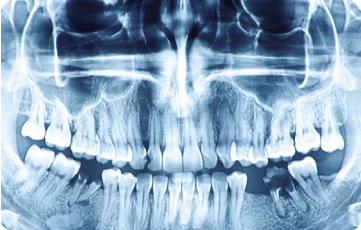 Cạo vôi răng 12 Chụp X Quang và lên phác đồ