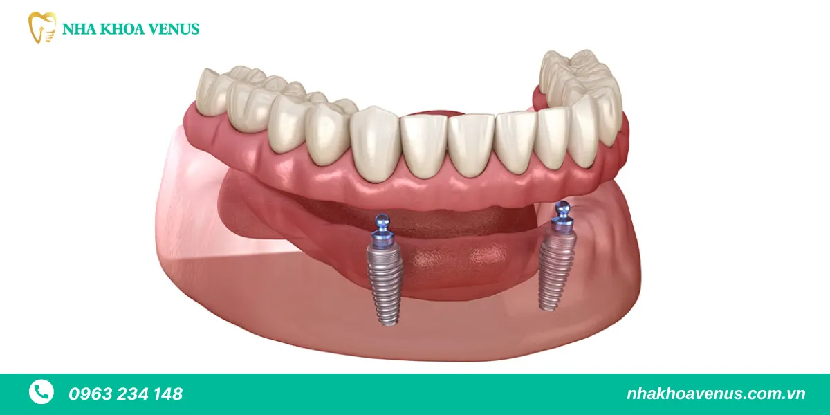 hàm tháo lắp trên implant