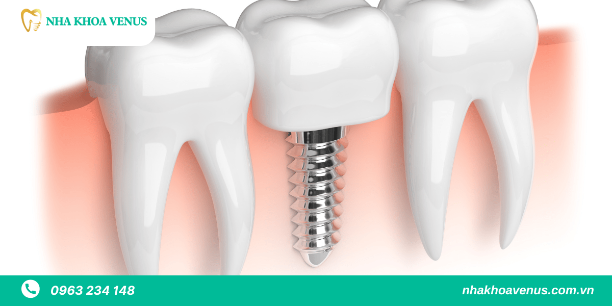 hối hận khi trồng implant