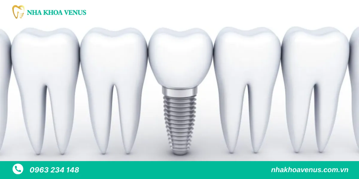 Implant dentium
