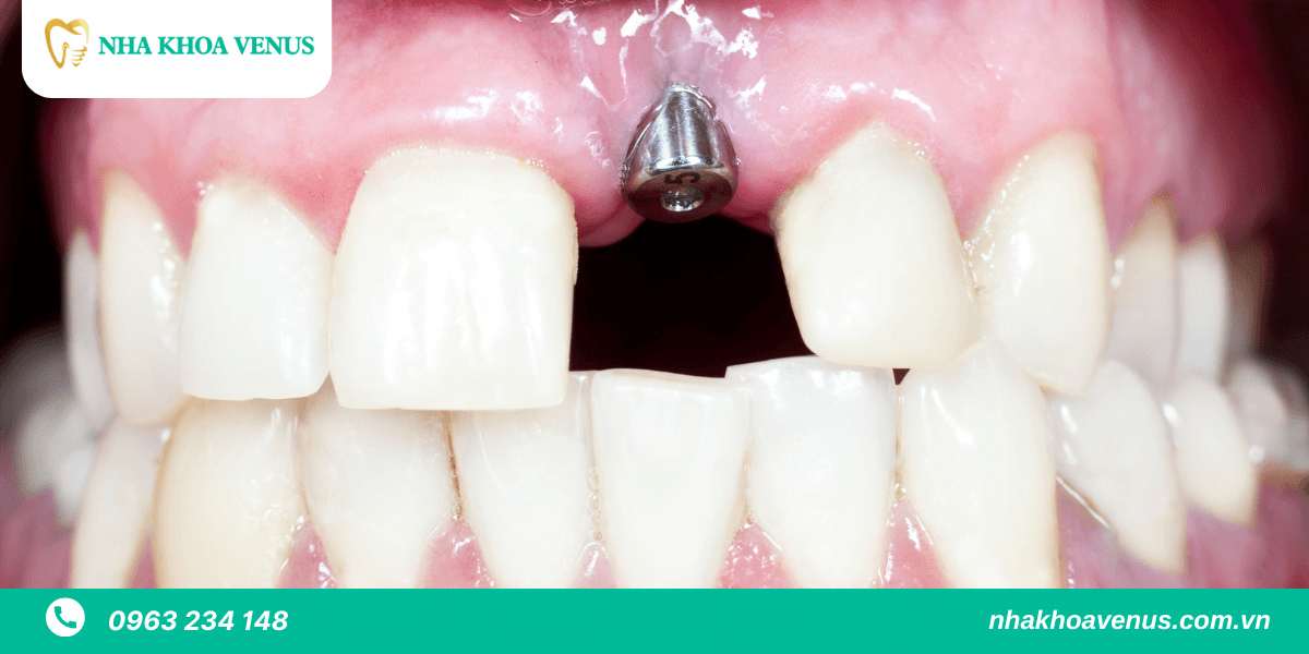 implant răng cửa