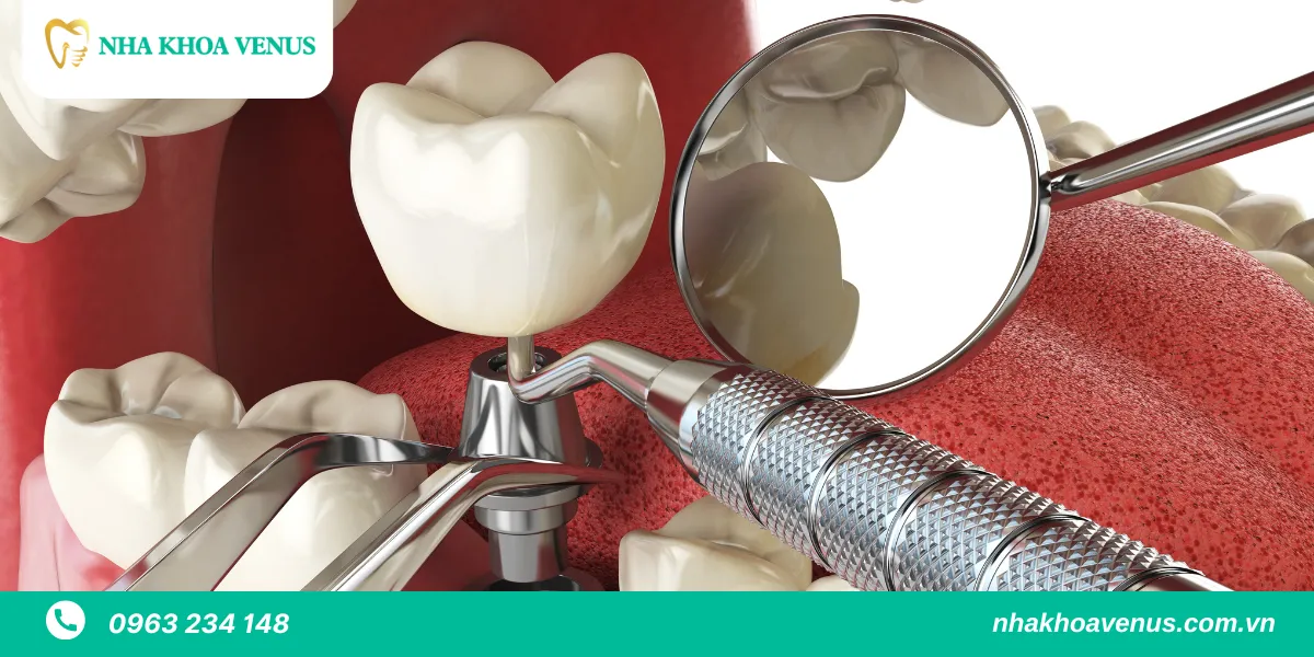 nhược điểm của trồng răng implant