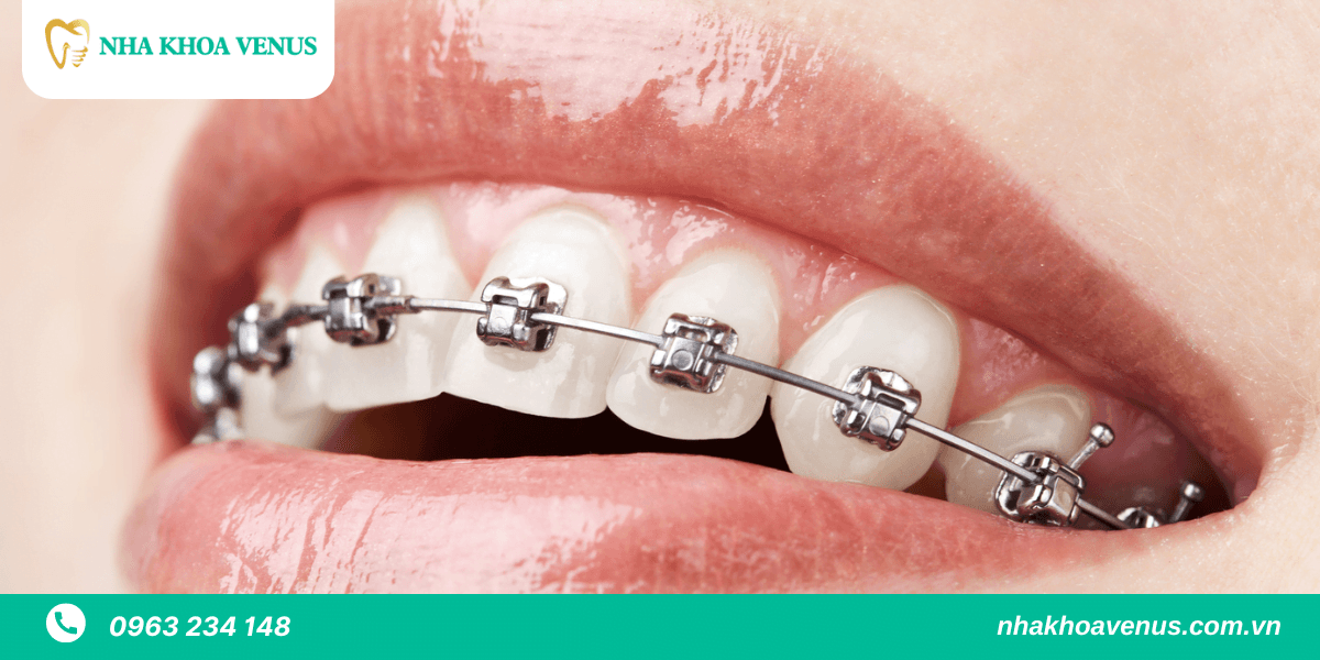 niềng răng có đau không