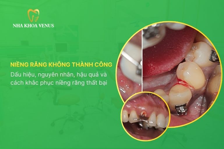 Niềng răng không thành công: Hình ảnh, dấu hiệu, nguyên nhân, hậu quả và cách khắc phục niềng răng thất bại