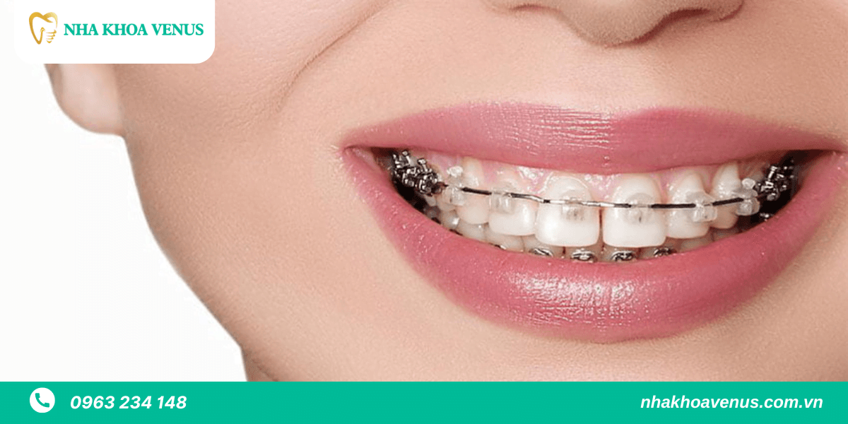 niềng răng thẩm mỹ