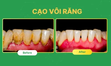 Cạo vôi răng 16 so sanh truoc va sau cao voi rang cạo vôi răng