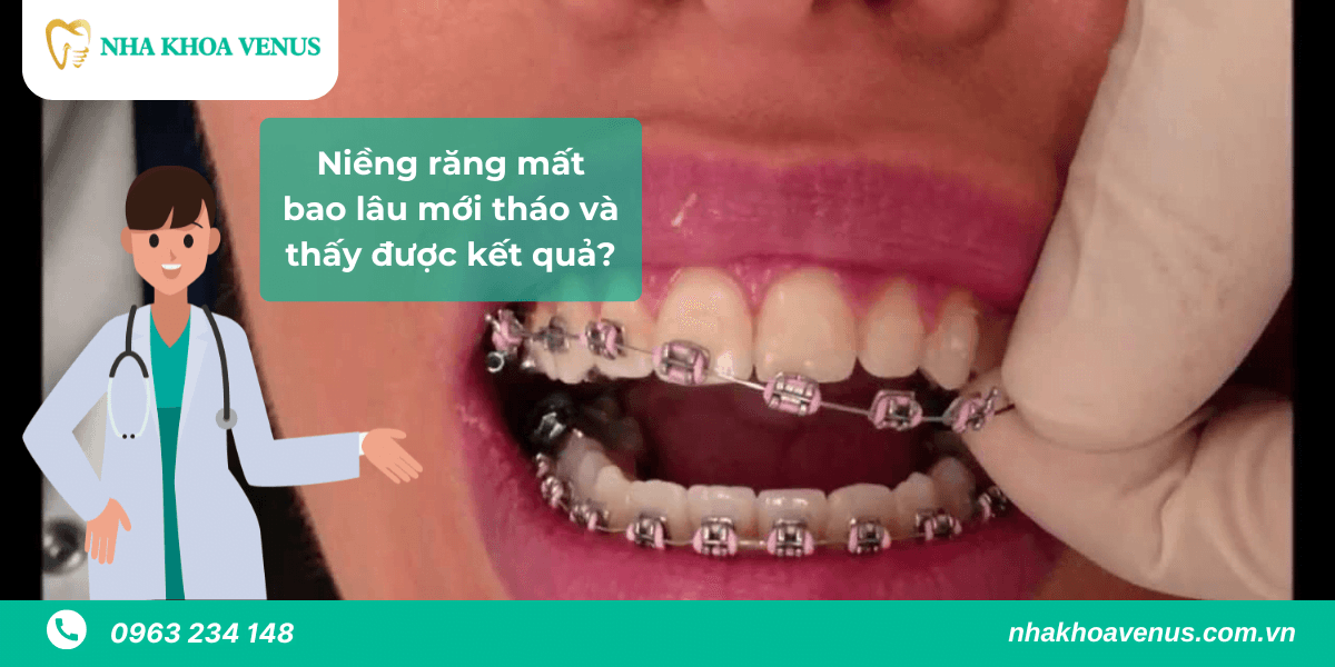 thời gian niềng răng mất bao lâu