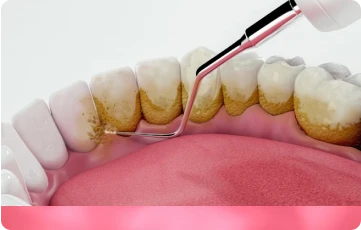 Cạo vôi răng 13 Tiến hành cạo vôi răng