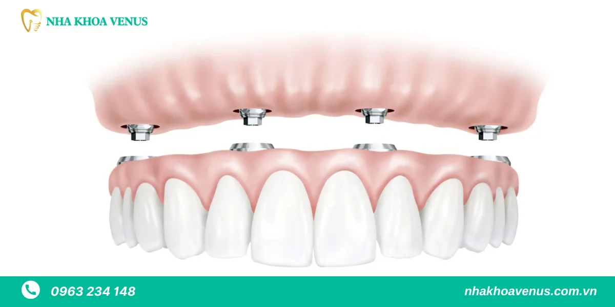 trồng răng implant all on 4