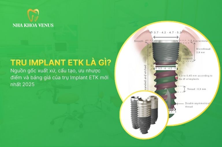 Trụ ETK Implant là gì? Nguồn gốc xuất xứ, cấu tạo, ưu nhược điểm và bảng giá của trụ Implant ETK mới nhất 2025