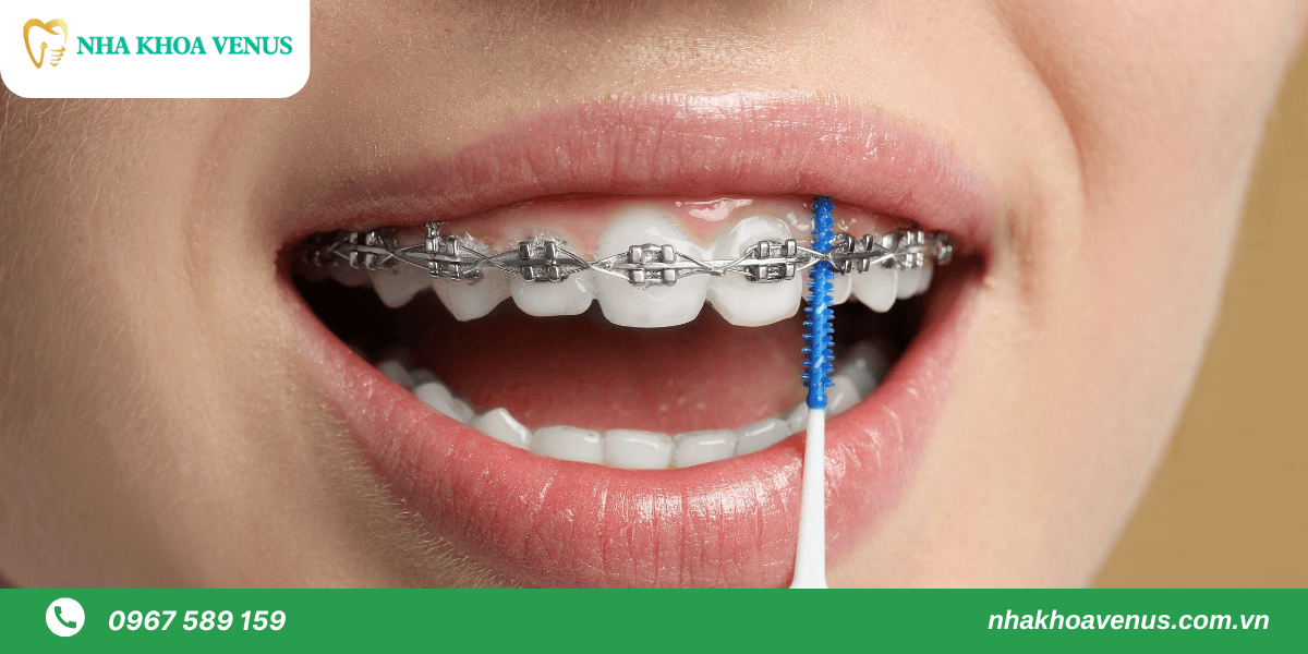 cách vệ sinh răng niềng