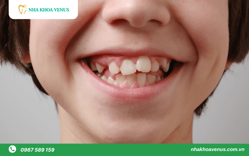 chỉnh răng mọc lệch không cần niềng