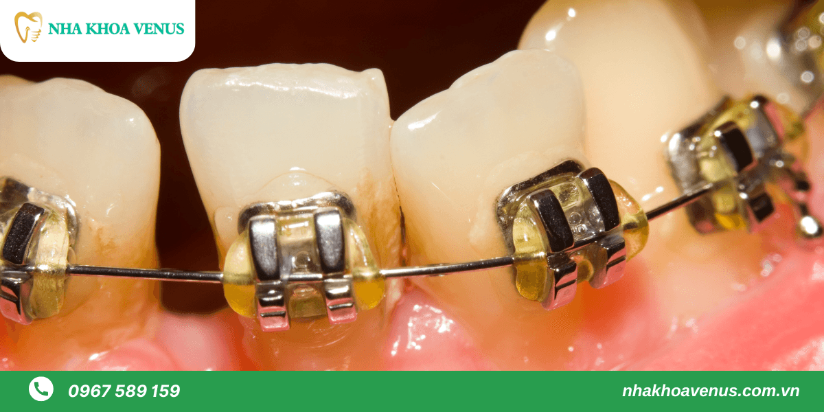 giai đoạn đóng khoảng trong niềng răng