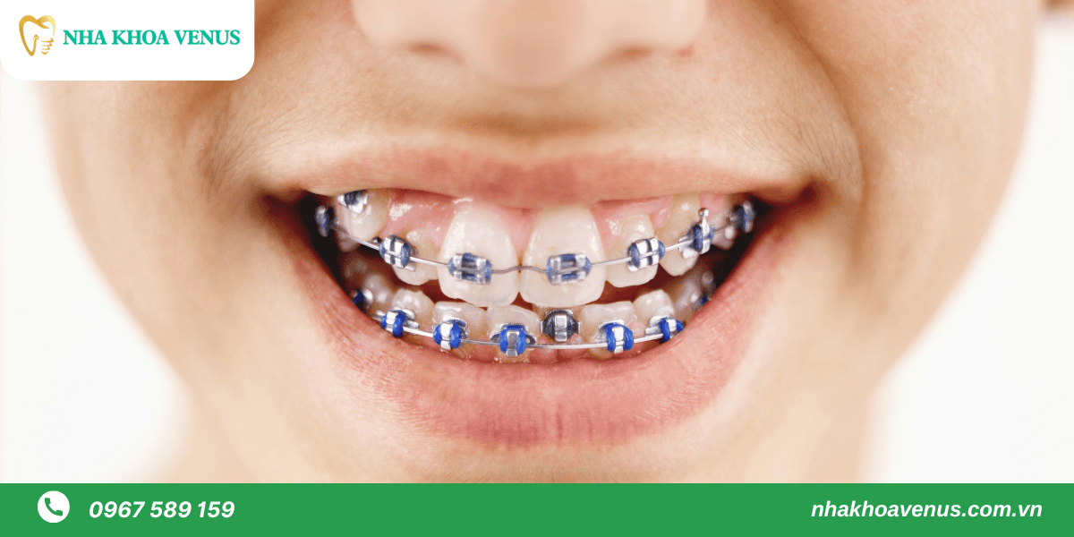 Giai đoạn xấu nhất khi niềng răng rơi vào khoảng 3 tháng đầu tiên