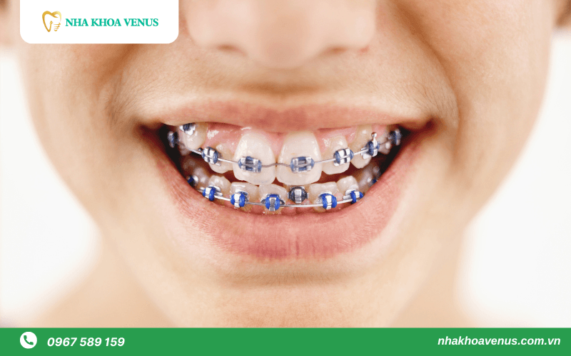 niềng răng mắc cài kim loại