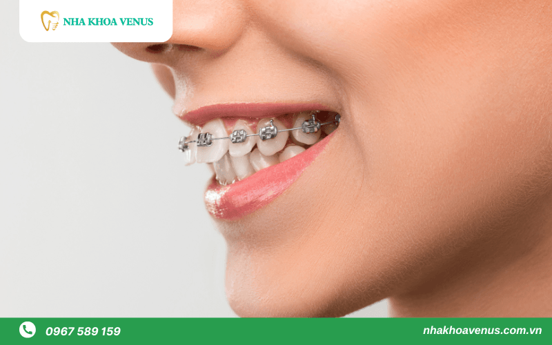 niềng răng mắc cài