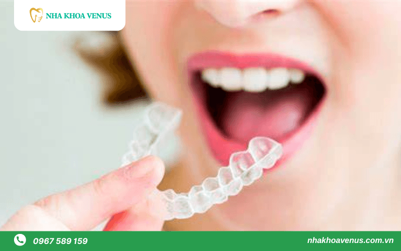 niềng răng trong suốt giá rẻ