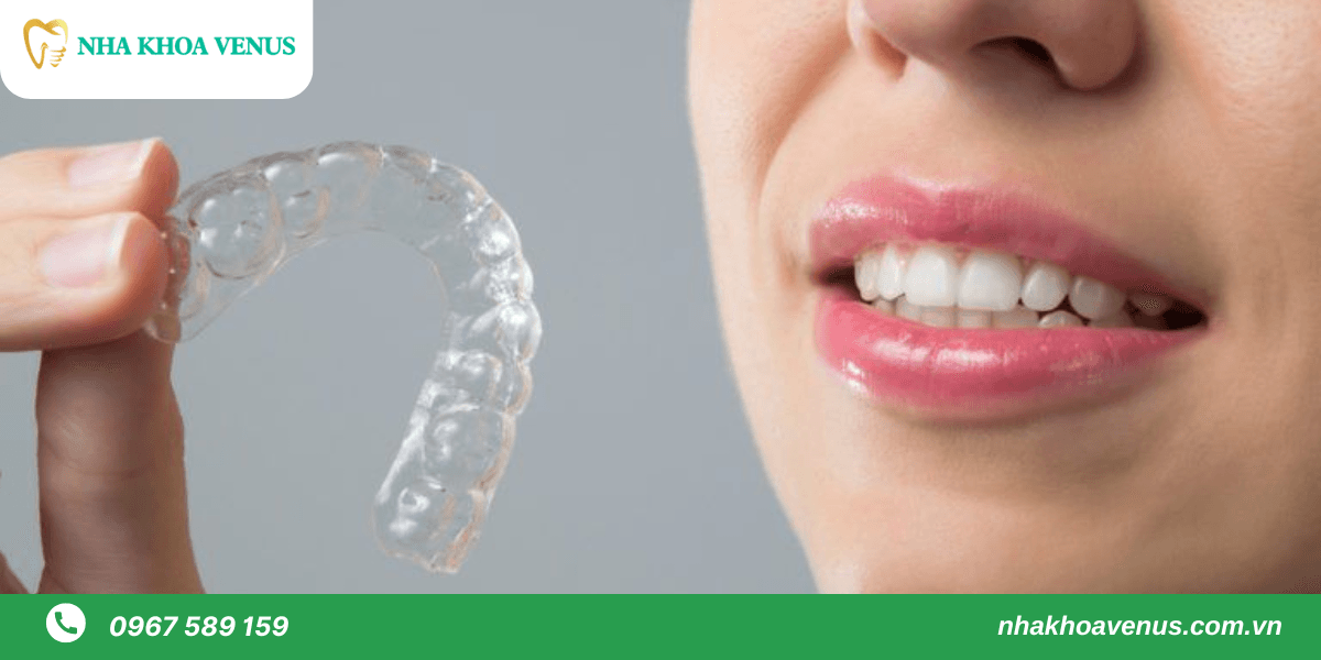 niềng răng trong suốt mất bao lâu