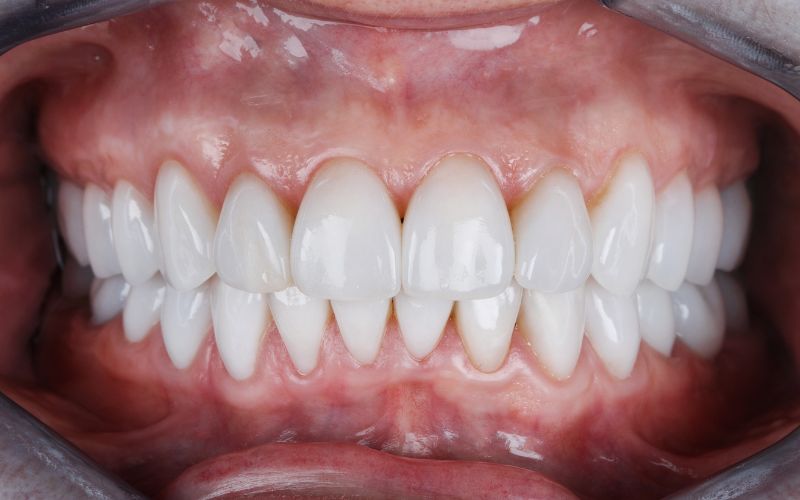 dịch vụ bọc răng sứ thẩm mỹ