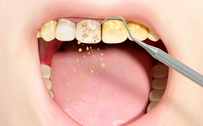 dịch vụ cạo vôi răng