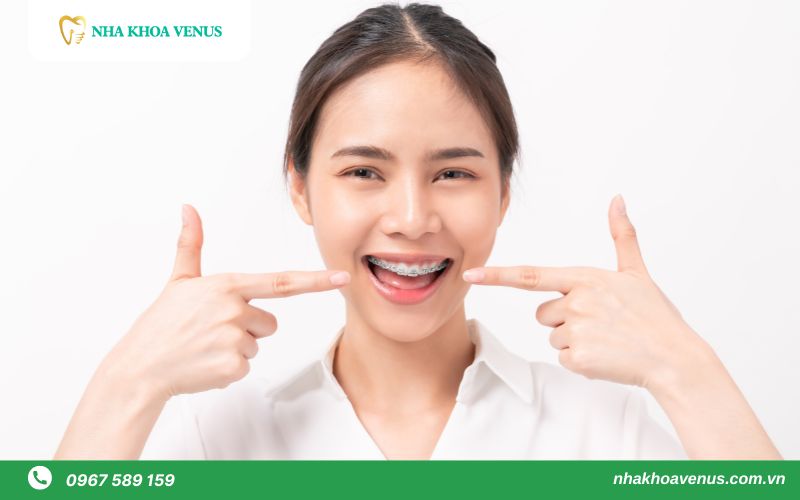 giá niềng răng mắc cài kim loại