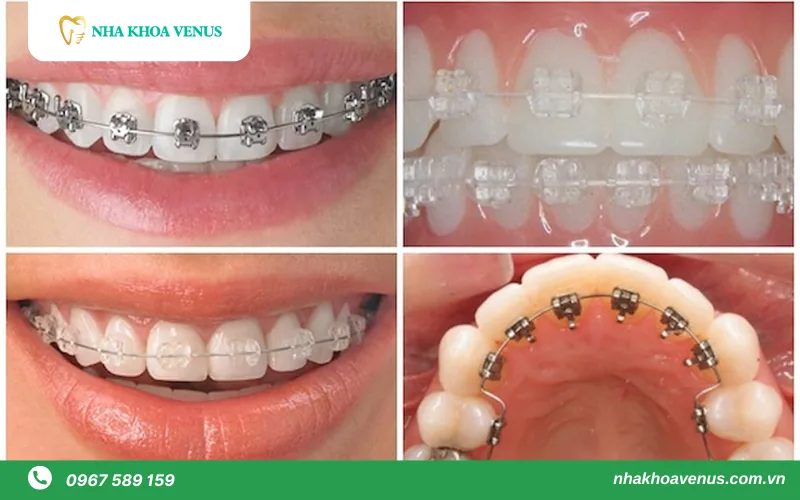 So sánh điểm giống và khác nhau của niềng răng mắc cài kim loại và niềng mắc cài sứ - Giải đáp: Nên niềng răng kim loại hay sứ? 4 Nên niềng răng kim loại hay sứ?