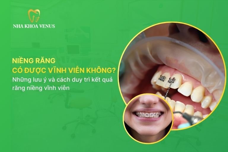 niềng răng có được vĩnh viễn không
