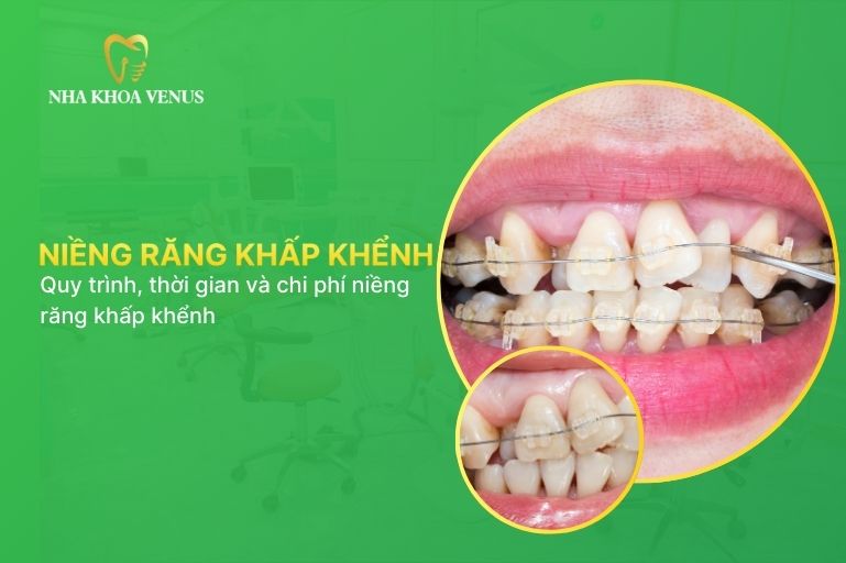 Niềng răng khấp khểnh