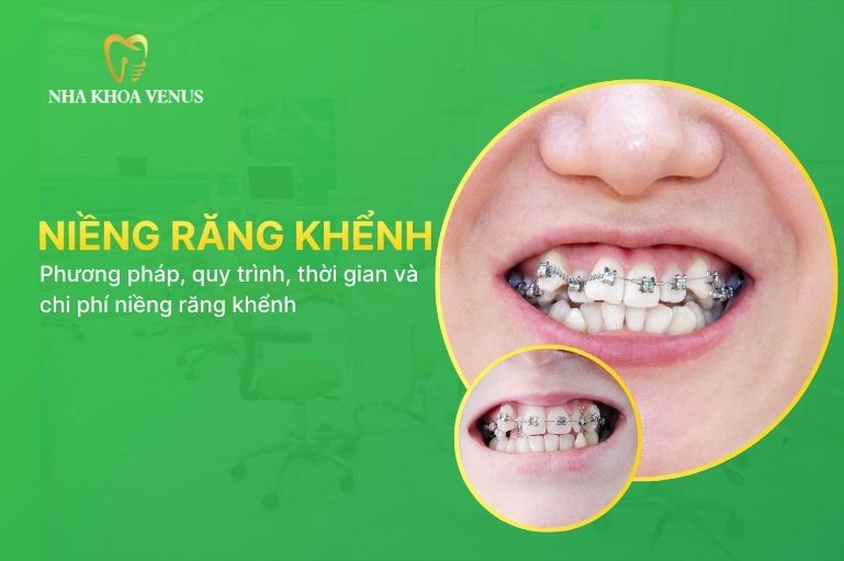 niềng răng khểnh