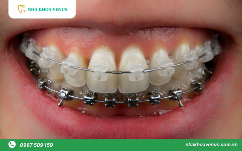 nên niềng răng mắc cài kim loại hay sứ