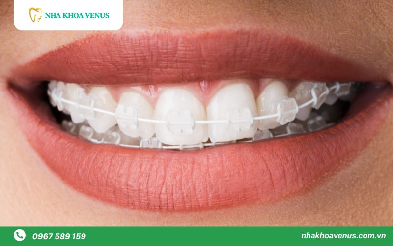 niềng răng mắc cài pha lê