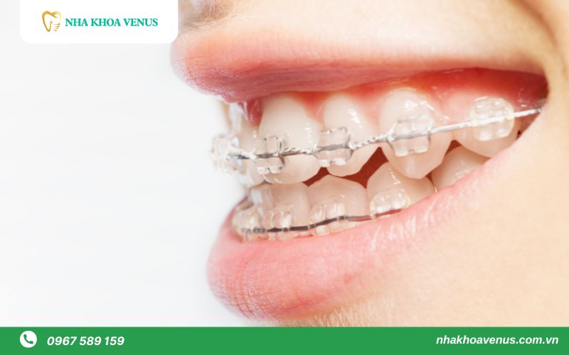 niềng răng mắc cài sứ