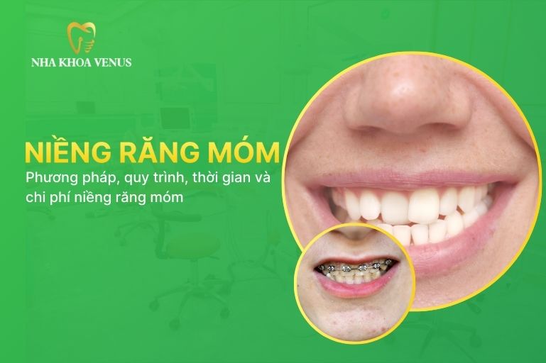 niềng răng móm