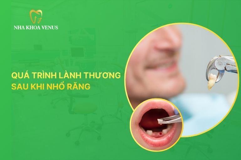 quá trình lành thương sau nhổ răng