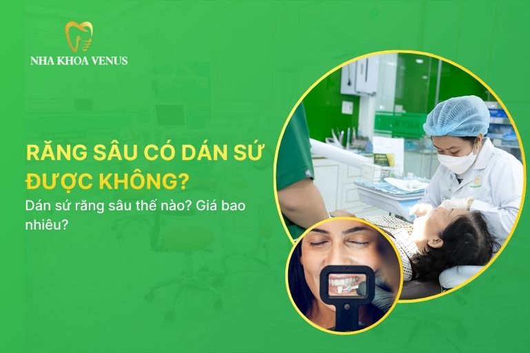 răng sâu có dán sứ được không