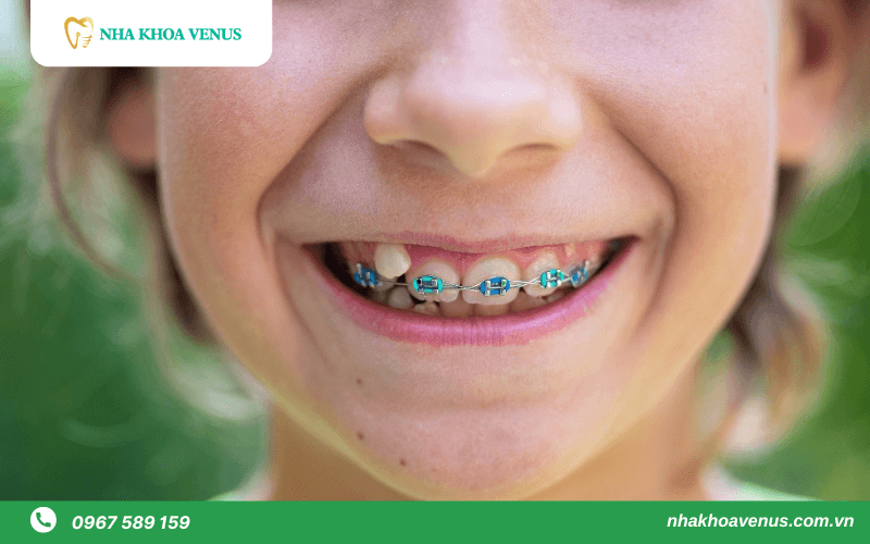 niềng răng 1 hàm có được không