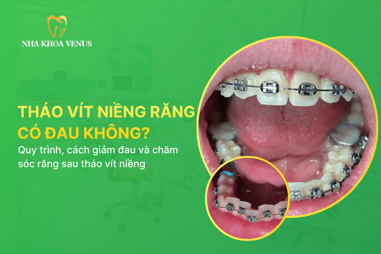 tháo vít niềng răng có đau không