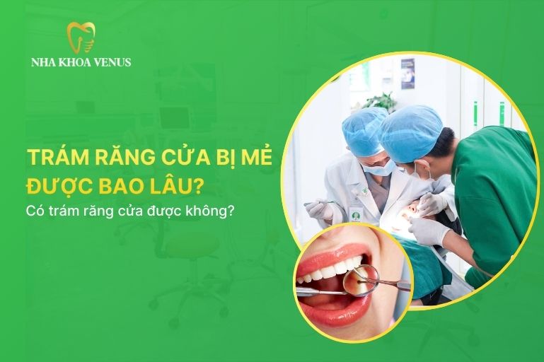 trám răng cửa bị mẻ được bao lâu